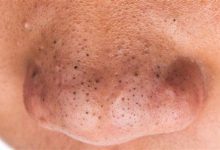 Siyah Nokta Temizleme ve Çıkarma: Dermatolog Önerileri ve Adımlar